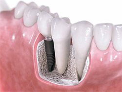 Implantología - Servicio de Odontología